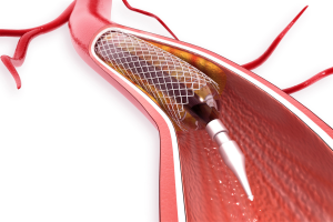 combien de stents peut-on recevoir
