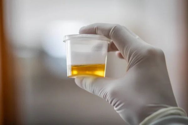 Conseils pratiques pour surveiller la santé de vos urines