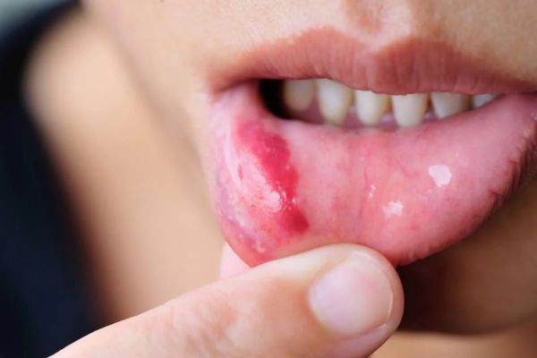 Vivre avec et après un cancer de la lèvre