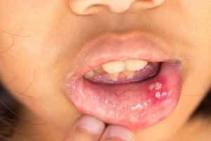 cancer de la lèvre inférieure