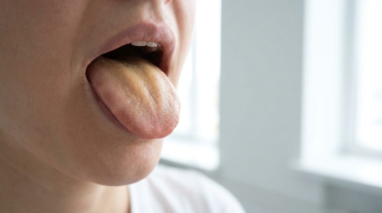 Pourquoi j’ai la langue jaune ? Causes et solutions