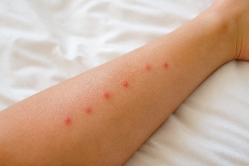 Piqure punaise lit : identifier et apaiser les symptômes