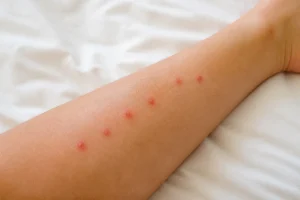 Morsures dinsectes sur la peau
