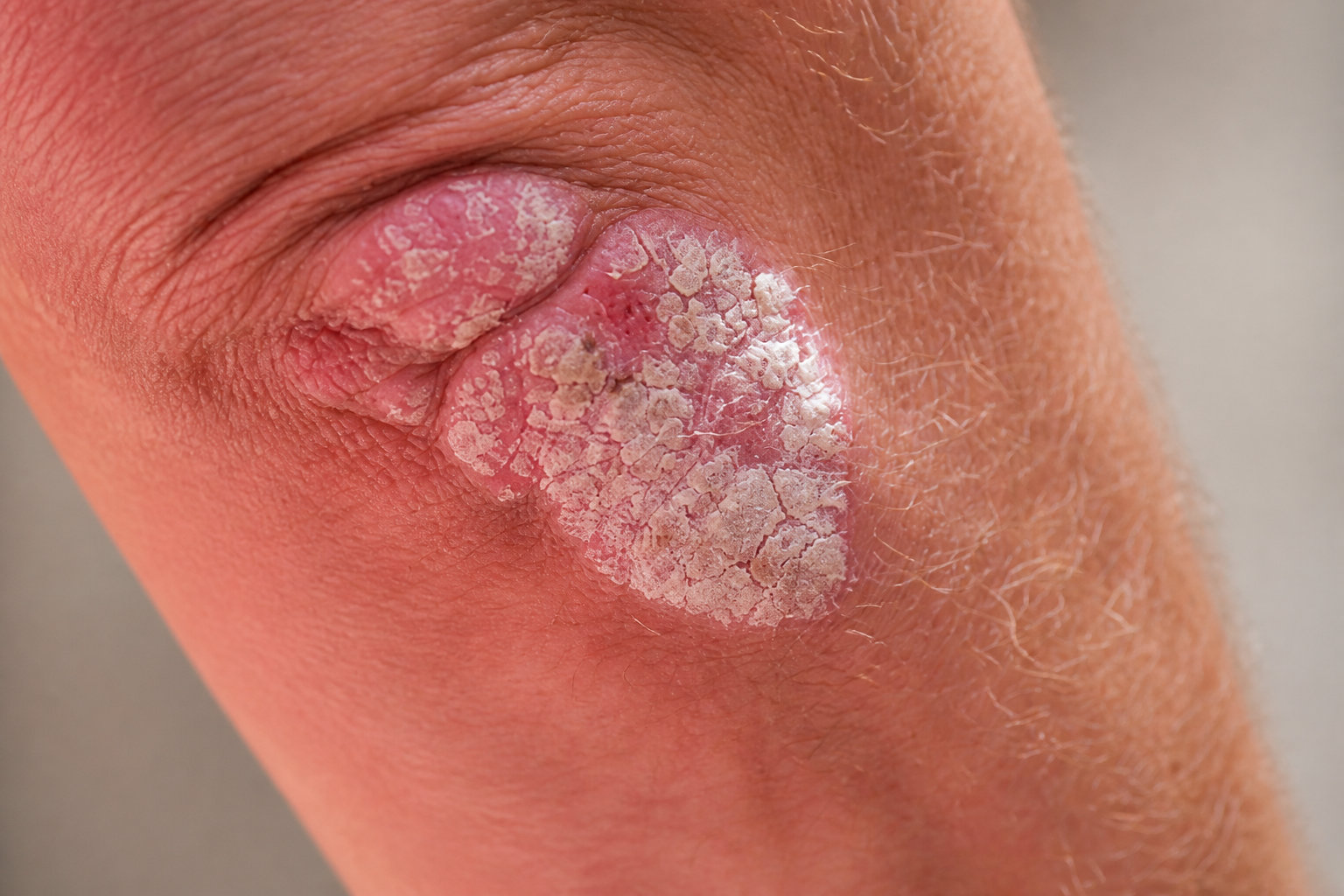 Identifier les symptômes et les différentes formes de psoriasis