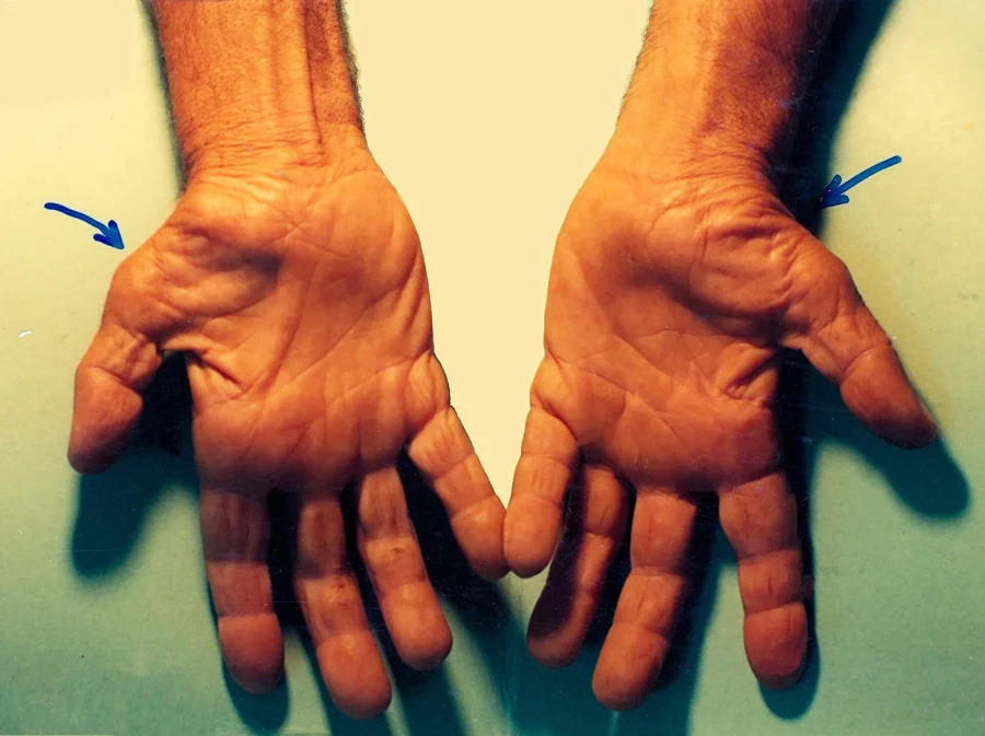 Paumes de deux mains avec des flèches montrant la fonte du muscle à la base du pouce