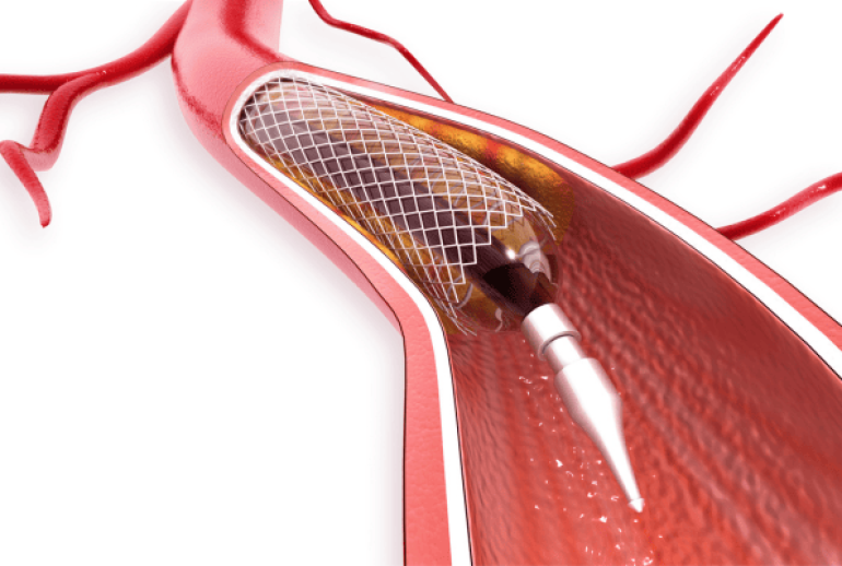 combien de stents peut-on recevoir