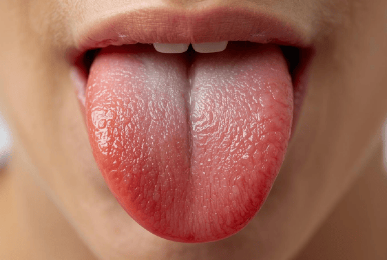bouton sur la langue remède naturel