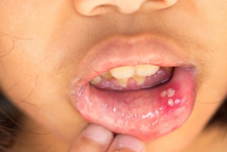 cancer de la lèvre inférieure