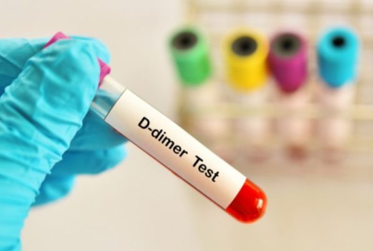 d-dimère et stress