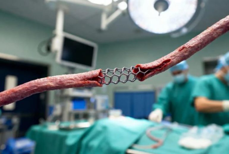 inconvénient stent