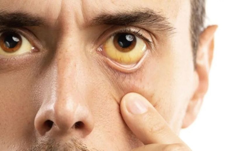 taux de bilirubine et cancer